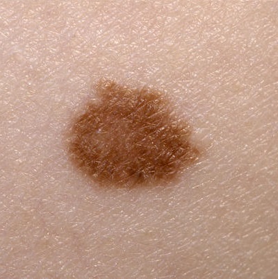 radiación solar y cáncer de piel